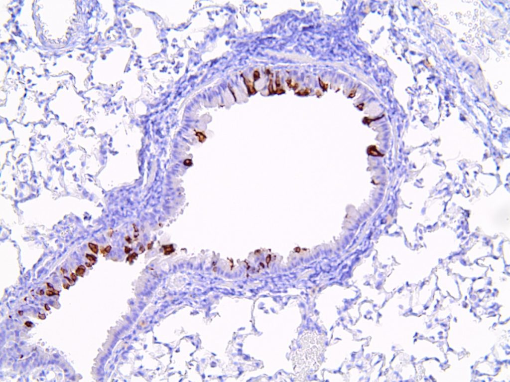 A microscopic view of a cotton rat lung infected with respiratory syncytial virus (infected cells shown in brown)